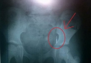 � ����������������� ����������� ��-�� ������ ����������� 5-������ ������� ��������� ������