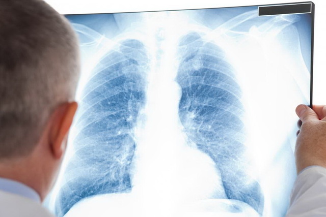 В прошлом году 118 каменчан заболели туберкулезом