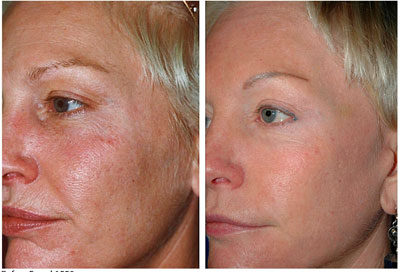 АКЦИЯ! К процедуре фракционного омоложения сеанс мезотерапии в ПОДАРОК!